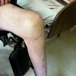 Dump Truck Crash Injury