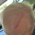 Dump Truck Crash Personal Injury Law