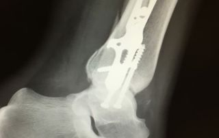 Pothole-injury-LaMarche-Safranko-Law-Personal-Injur